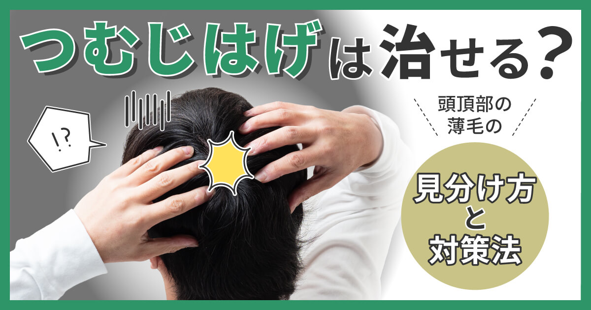 つむじはげは治せる？頭頂部の薄毛の見分け方と対策法