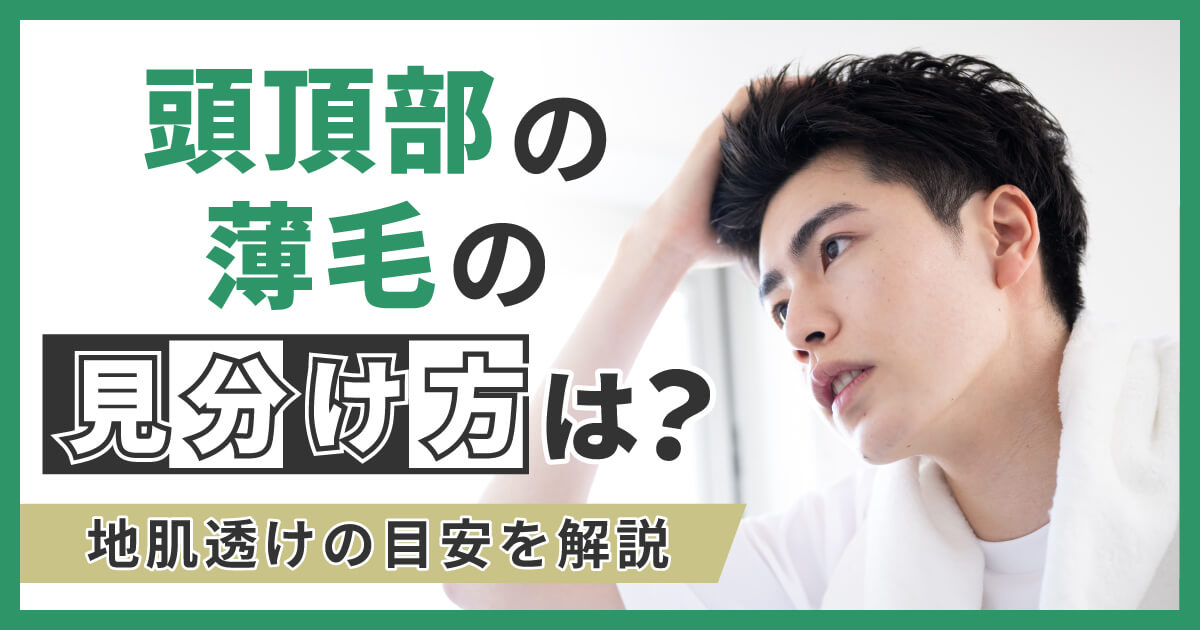 頭頂部の薄毛の見分け方は？地肌透けの目安を解説