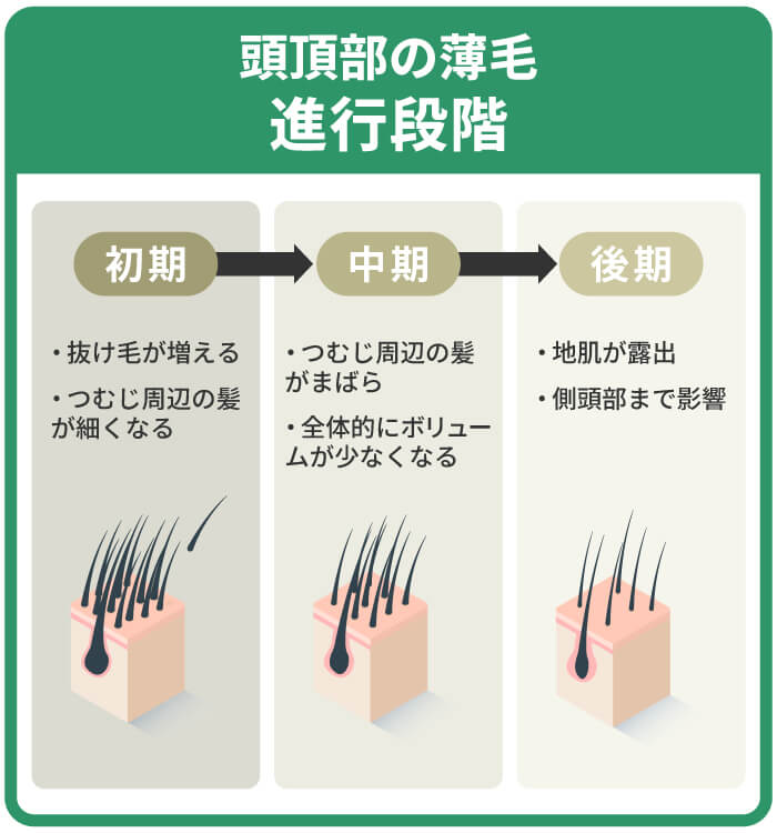 頭頂部の薄毛進行段階